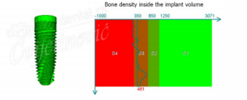 gustina kosti u implantu