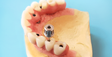 All on X zubni implanti