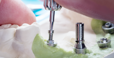 proteze na zubnim implantima