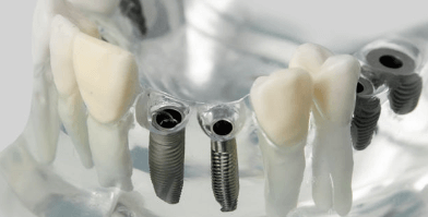 kombinovani implantološki radovi
