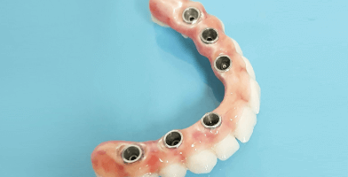 zubni implanti All on 6
