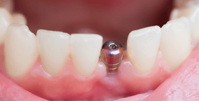 bezbolna ugradnja zubnih implanata