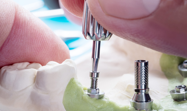 proteze na zubnim implantima
