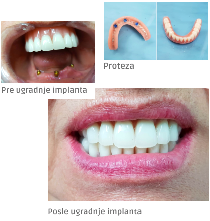 proteze na zubnim implantima pre i posle